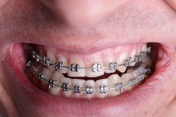 金属矫正牙套对弯曲丑陋的牙齿近距离。丑陋的微笑。牙科概念，医学对齐牙齿，托槽矫正医生图片下载