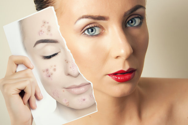 年轻女子的肖像照片与她的斑点皮肤图片下载