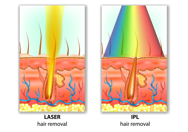 IPL(强脉冲光)和激光脱毛图片下载