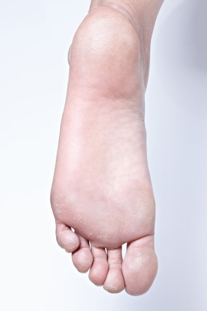 干燥粗糙的鞋底。死皮细胞和干足。图片下载