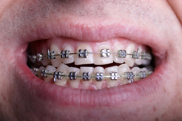金属矫正牙套对弯曲丑陋的牙齿近距离。丑陋的微笑。牙科概念，医学对齐牙齿，托槽矫正医生图片下载