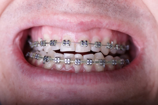 金属矫正牙套对弯曲丑陋的牙齿近距离。丑陋的微笑。牙科概念，医学对齐牙齿，托槽矫正医生图片下载