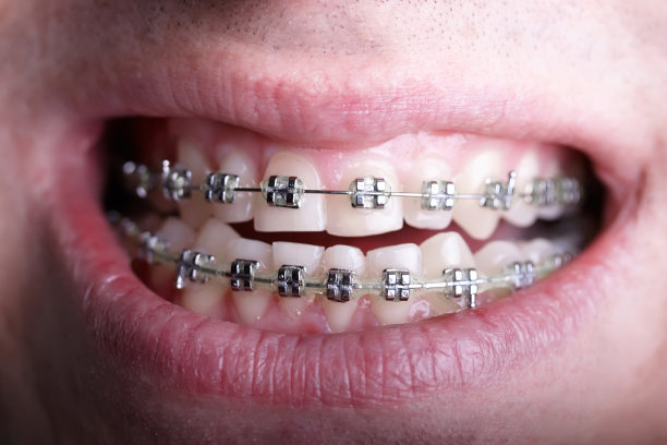 金属矫正牙套对弯曲丑陋的牙齿近距离。丑陋的微笑。牙科概念，医学对齐牙齿，托槽矫正医生图片下载