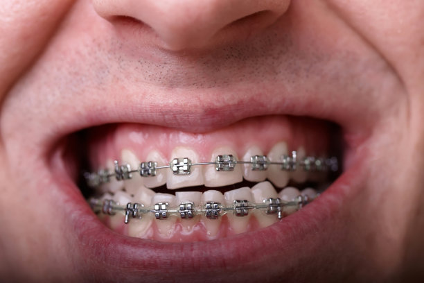 金属矫正牙套对弯曲丑陋的牙齿近距离。丑陋的微笑。牙科概念，医学对齐牙齿，托槽矫正医生图片下载