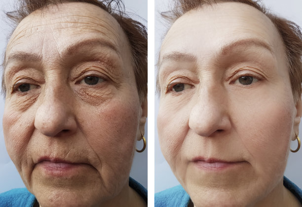 老妇脸上的皱纹前后程序修饰图片下载