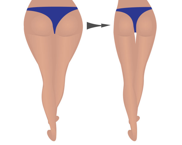 臀部减肥。脂肪和苗条。之前和之后图片下载