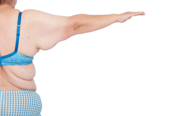 极度减肥后手臂皮肤松弛过多的中年妇女。在臂成形术，膜切除术，腹部成形术和木乃伊美容之前。右臂完全后视图。图片下载