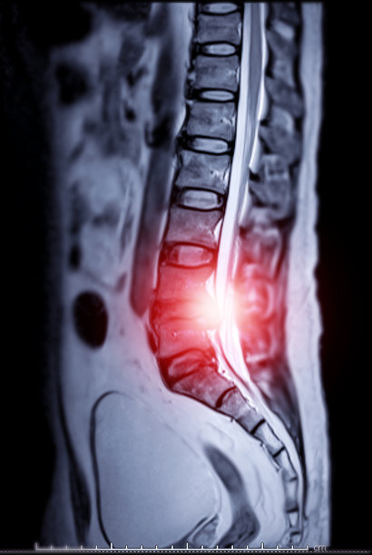 矢状位上的骶椎或L-S椎MRI。图片下载