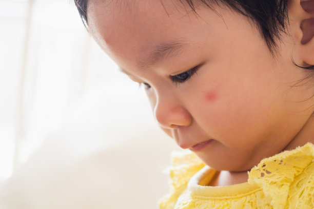 可爱的亚洲小女孩因昆虫叮咬引起的面部过敏红斑图片下载