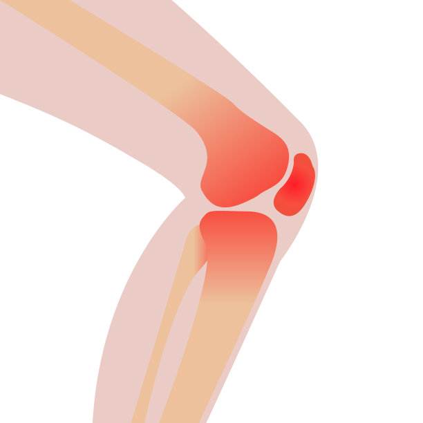 因受伤引起的膝盖疼痛和炎症图片下载