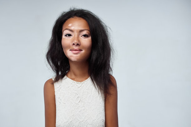 美丽的非洲女孩在工作室与皮肤问题白癜风工作室拍摄图片下载