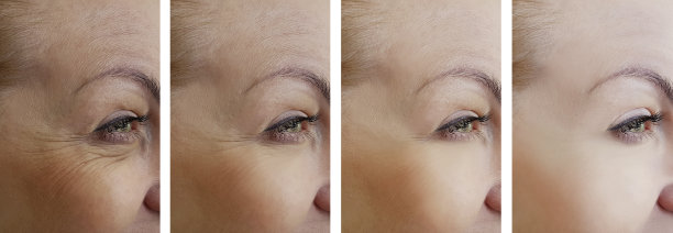 女性在治疗后会出现皱纹图片下载