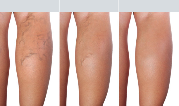 静脉曲张的治疗图片下载