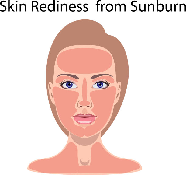 女性面部和颈部皮肤发红。矢量说明紫外线的危险。图片下载