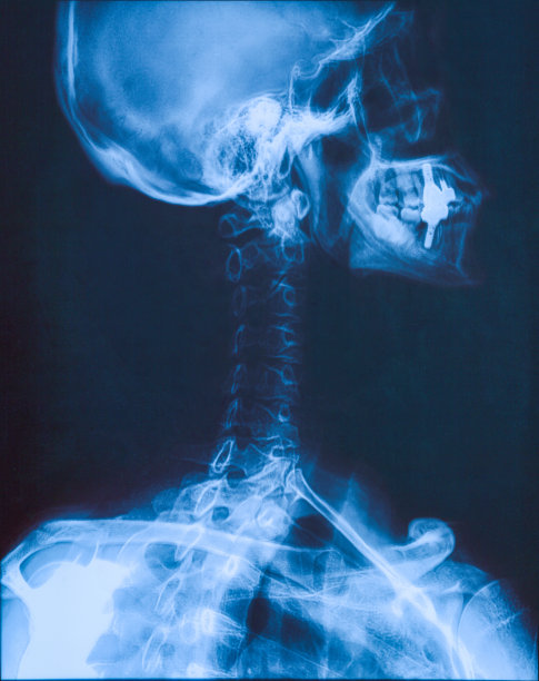 颈部x光片图片下载