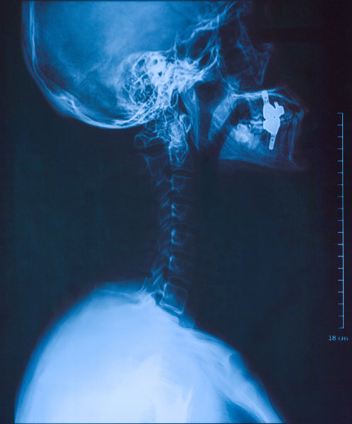 颈部x光片图片下载