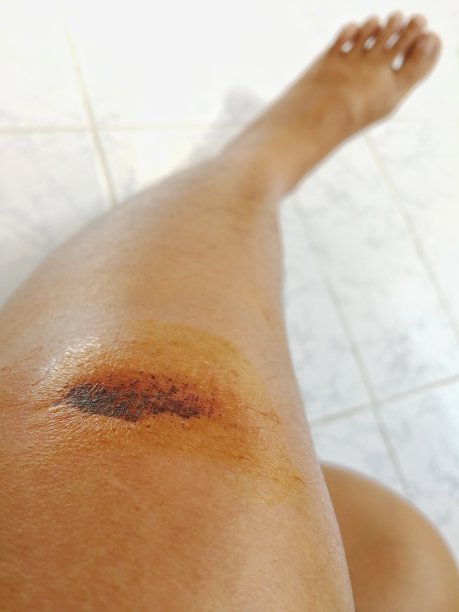 膝部结痂，摔伤，药物治疗图片下载