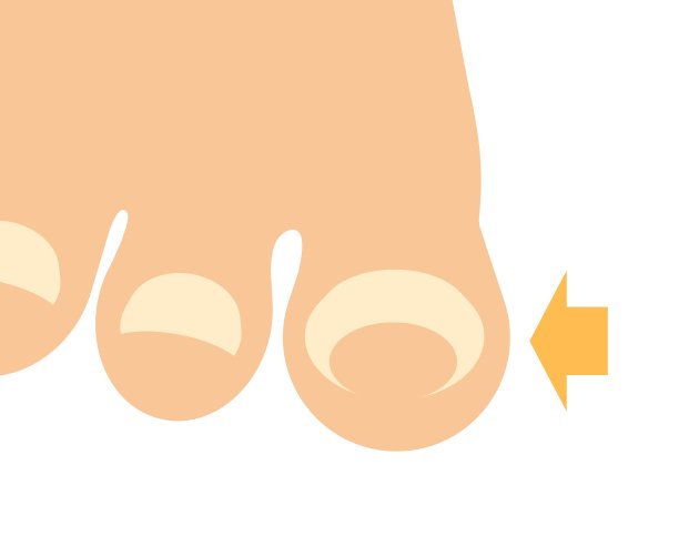 畸形的钉子图片下载