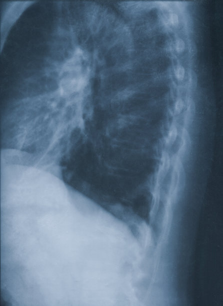 胸廓x线片图片下载