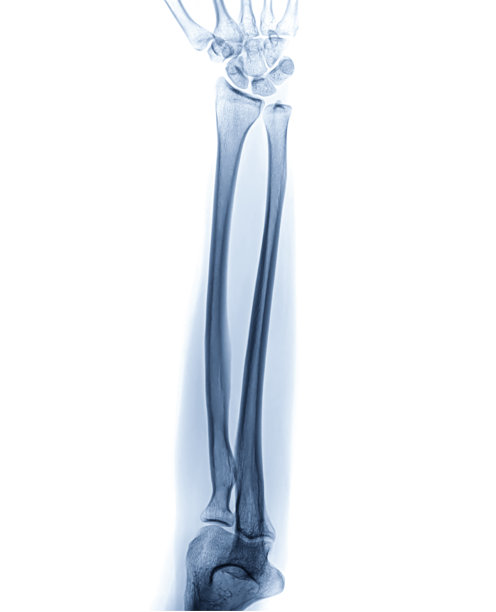 左前臂的x线照片或x线照片显示正常的前臂正位面。图片下载