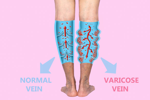 一位老年女性腿部静脉曲张。正常和静脉曲张的结构。图片下载