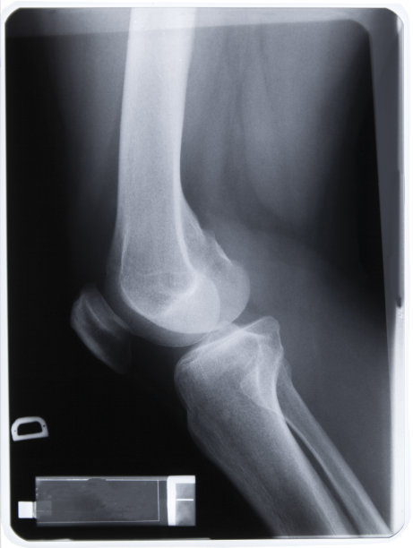 57岁女性膝关节骨扫描关节炎进展图片下载