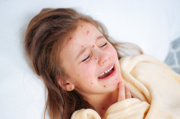 可爱的伤心哭泣的小女孩在床上的特写。水痘病毒或水痘泡疹的儿童素材图片