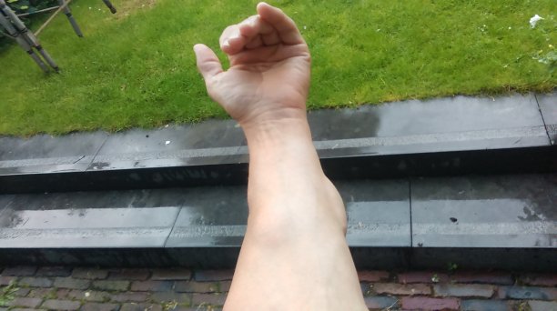 脂肪瘤的身体图片下载