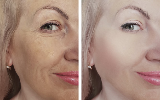 女人在治疗前后脸上有皱纹图片下载