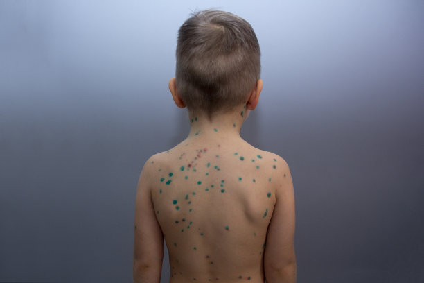 得了水痘的伤心男孩。患病儿童水痘。素材图片