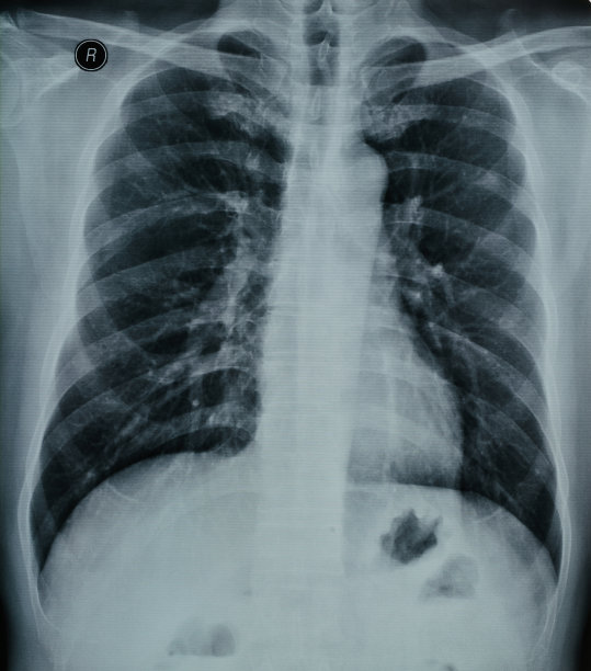 人体胸部x光片图片下载