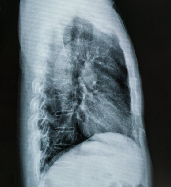 人体胸部x光片图片下载