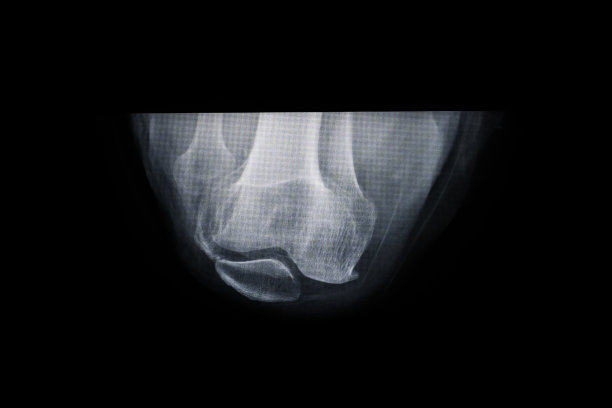 人类腿部关节，膝盖x光片图片下载