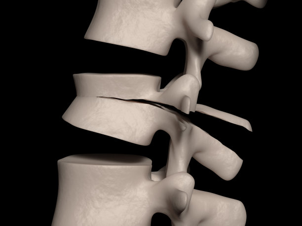 第二腰椎偶然(安全带损伤)骨折(腰椎骨折)图片下载