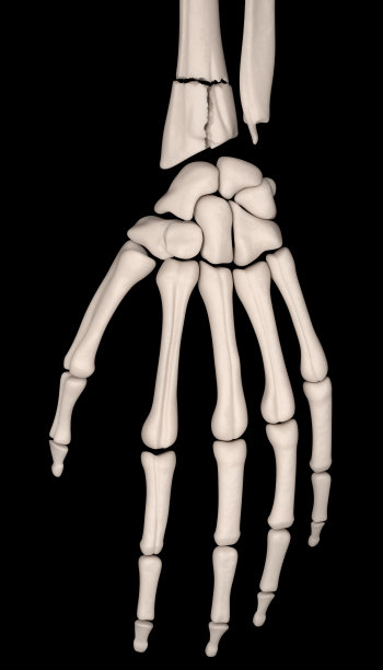 腕关节内骨折，桡骨远端无移位骨折图片下载