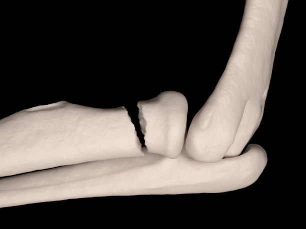 肘关节桡骨头骨折图片下载