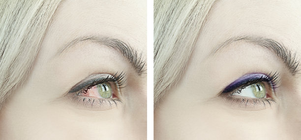 妇女红眼前后的程序图片下载