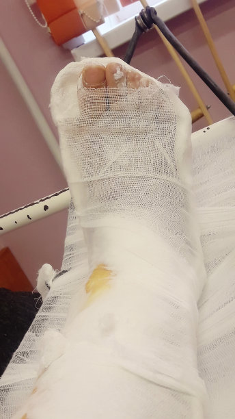 一个男人在跑步受伤后的玻璃纤维/石膏腿的特写。图片下载