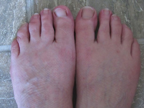 脚肿了，没穿鞋图片下载