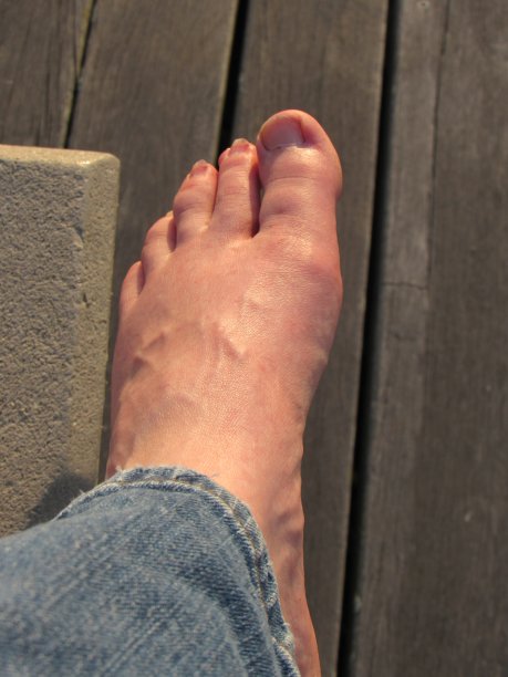 肿胀的脚图片下载