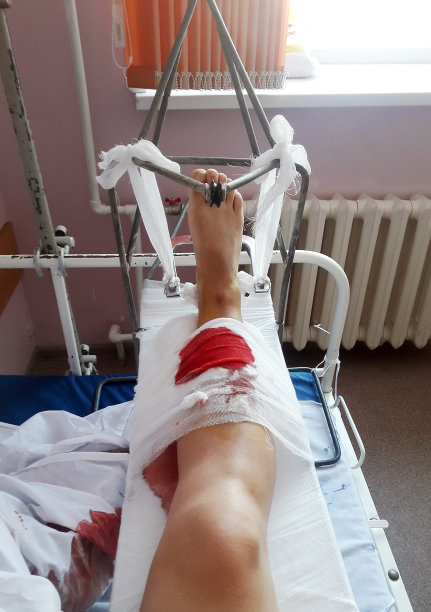 伊里扎罗夫的腿骨骨折的医疗固定，骨折的延伸在医院。图片下载