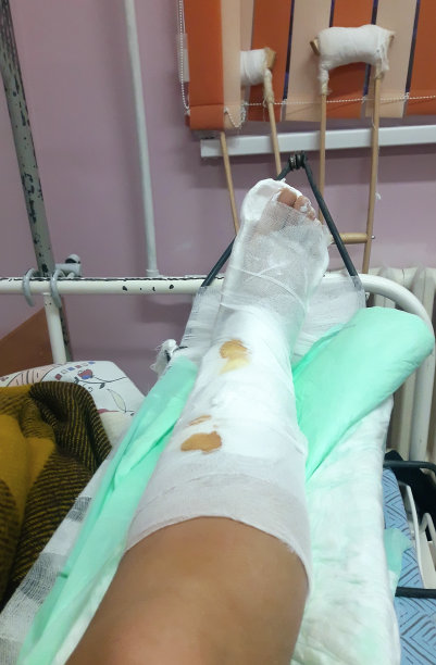 骨折后石膏腿。图片下载