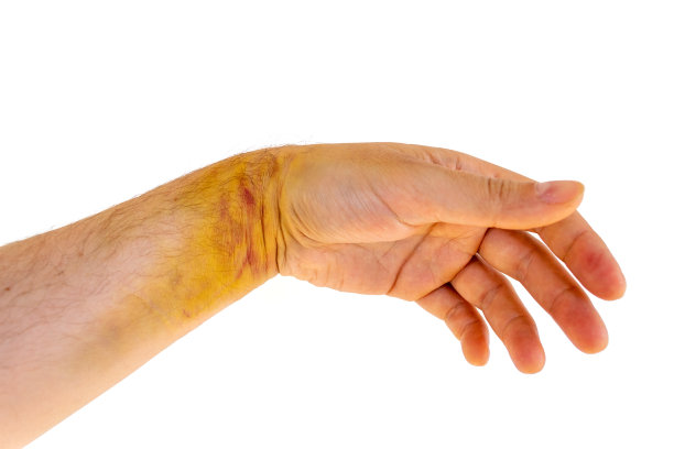 手腕扭伤伴有黄色和紫色瘀伤，在白色背景下孤立出现，这是许多运动员常见的损伤。男性手部扭伤后手腕韧带撕裂。图片下载