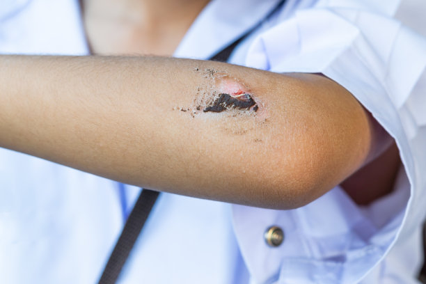 孩子肘部的伤口图片下载