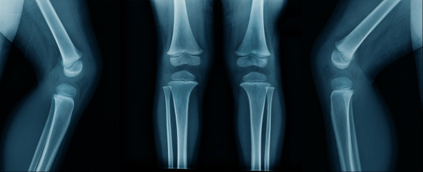 蓝色的膝盖x光片图片下载
