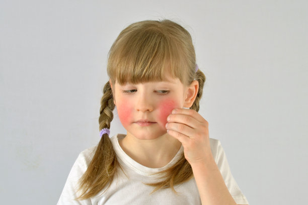 儿童，儿童，皮肤病皮炎发红刺激过敏素材图片