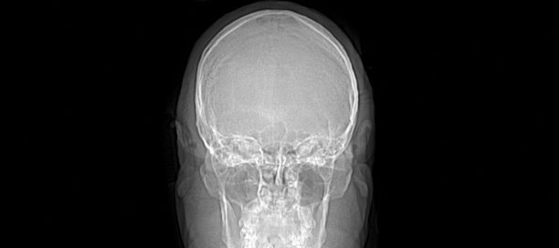 健康组织的磁共振成像(MRI)人脑冠状动脉测试报告(也称CT扫描或计算机轴向断层扫描)图片下载