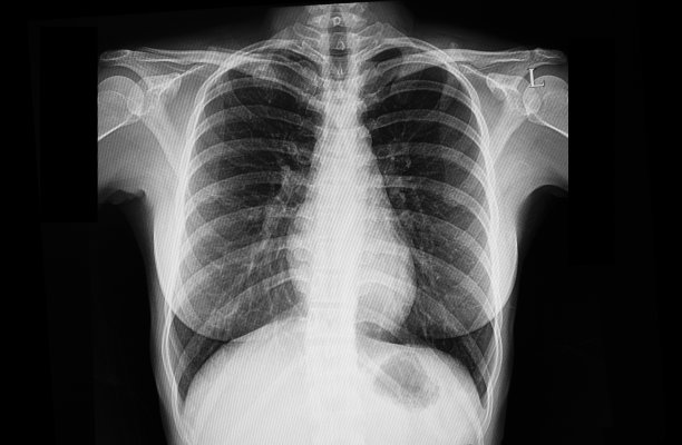 肺结核图片下载