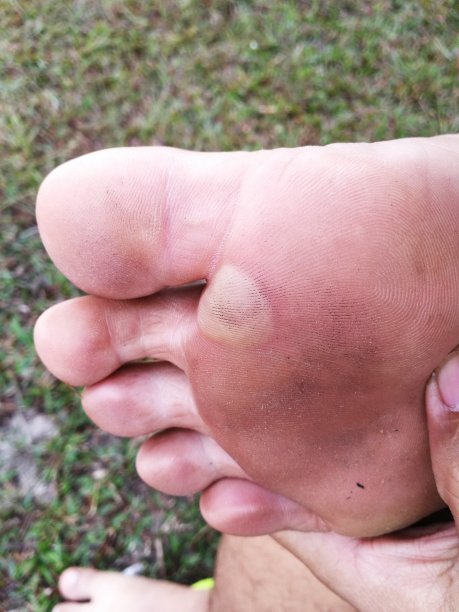 走了一天，脚肿了图片下载