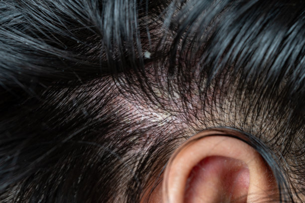 头皮上的皮肤病图片下载